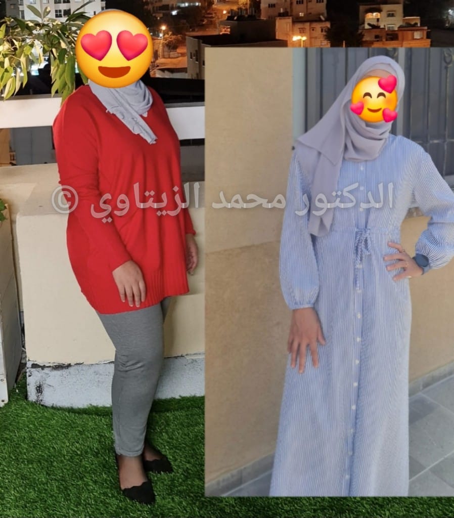 before-after (4)